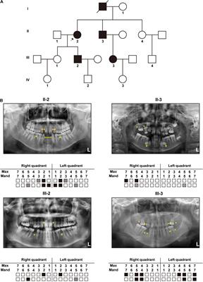 Investigation of a Novel LRP6 Variant Causing Autosomal-Dominant Tooth Agenesis